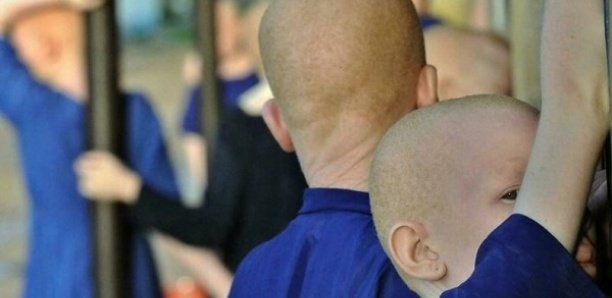 Burundi : Un enfant albinos tué et démembré