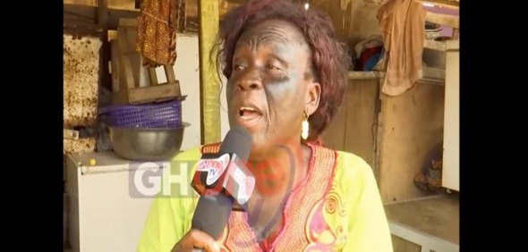 Ghana: Elle perd la vue dans ses tentatives de se blanchir la peau