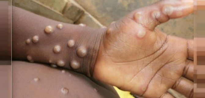 Mpox : L'OMS prolonge son niveau d'alerte maximale