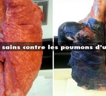 Aux fumeurs : ces 4 ingrédients peuvent nettoyer les poumons de la nicotine et du goudron