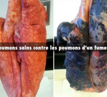 Attention danger: Les cigarettes light ont fait exploser le cancer du poumon