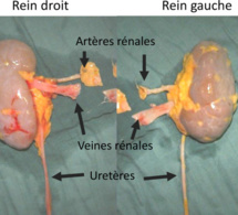 Santé : Plus de 25 millions FCfa pour se faire transplanter un rein